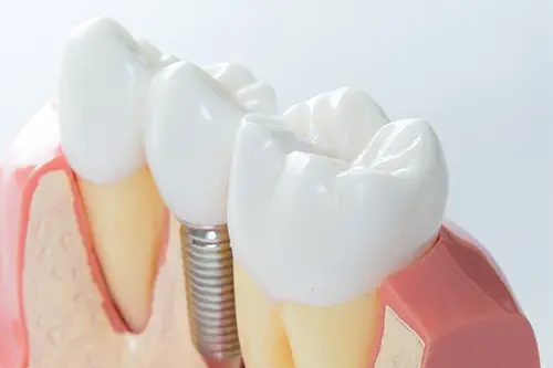 2025-05-21-molar-implant