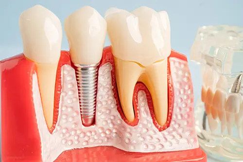 2025-06-23-dental-implants