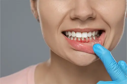 2025-10-14-gum-disease