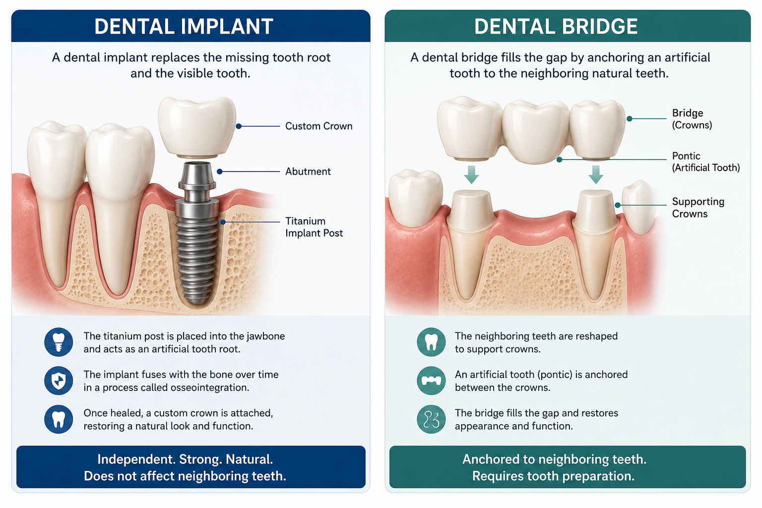 Side-by-side comparison of a dental implant and a dental bridge replacing a missing tooth. The implant diagram shows a titanium implant post placed in the jawbone with an abutment and crown, while the bridge diagram shows an artificial tooth supported by crowns attached to neighboring teeth.