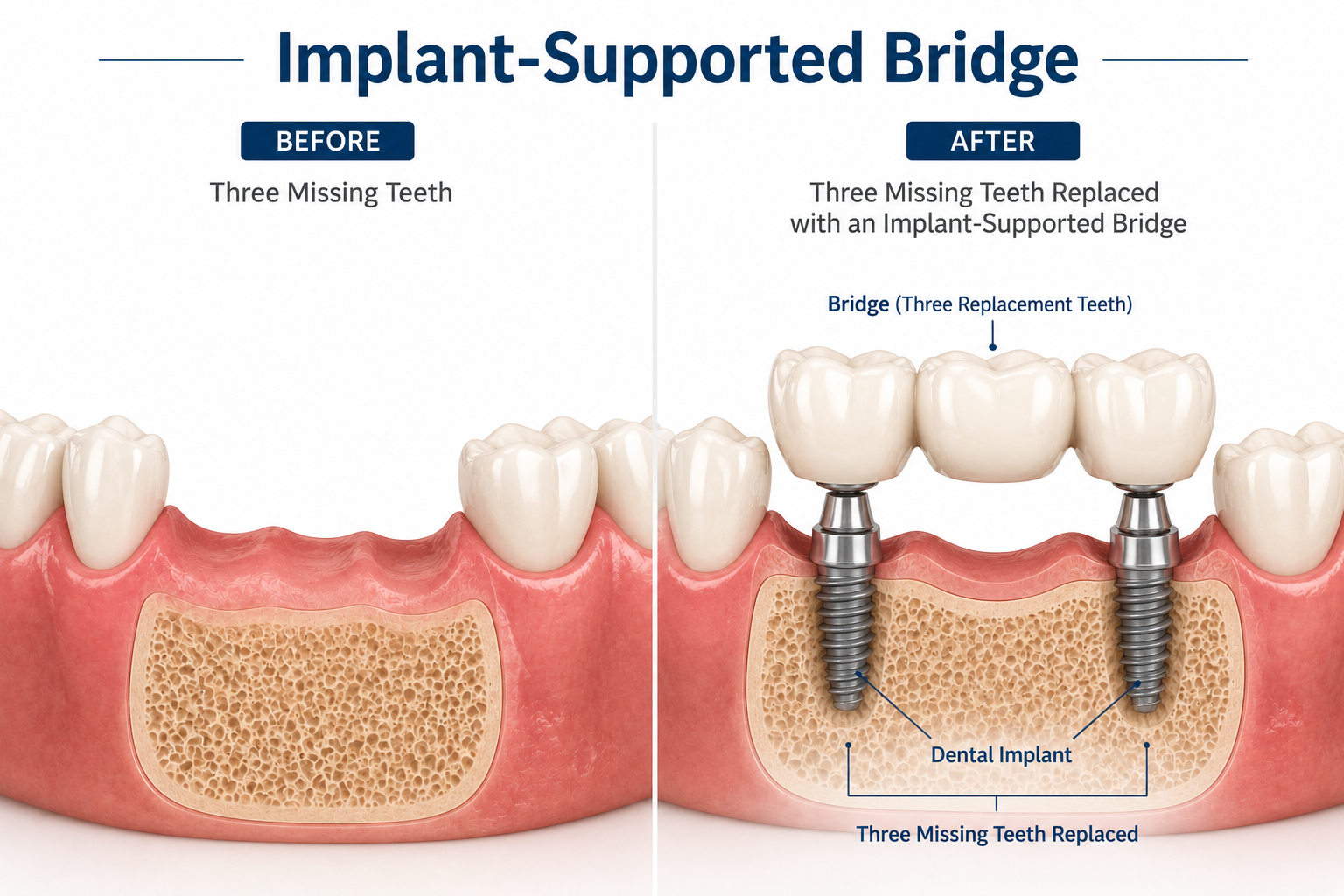 Before-and-after illustration showing three missing teeth replaced with an implant-supported bridge. The image compares a gap caused by three missing teeth with a restoration supported by two dental implants and a three-tooth bridge.