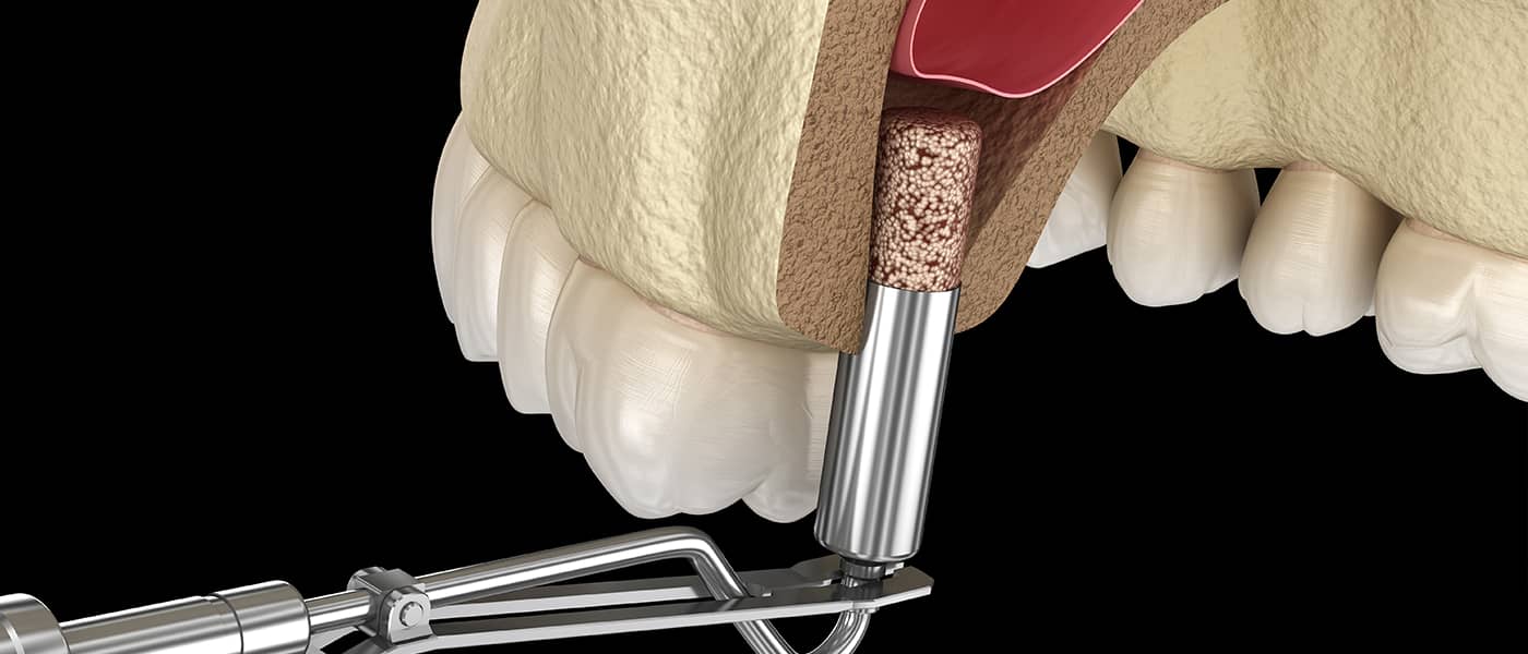 Sinus Augmentation