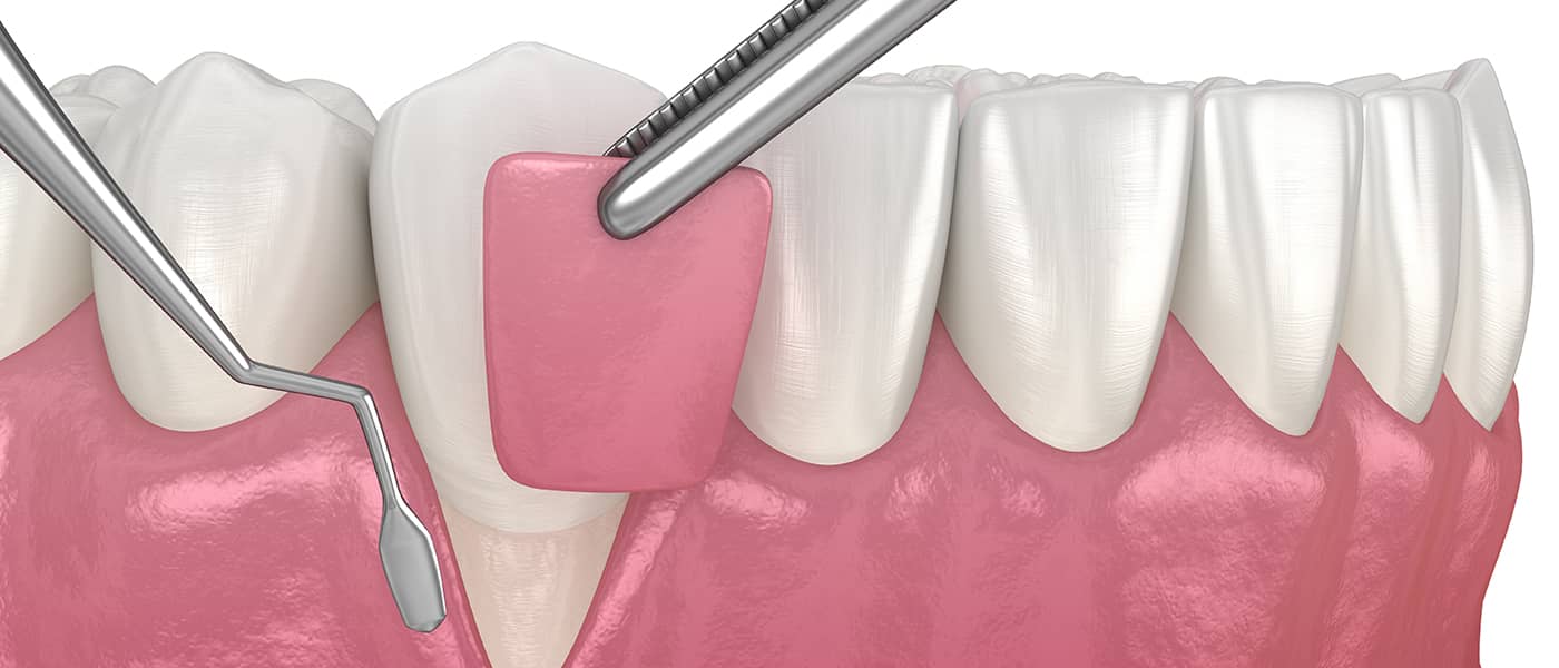 Gum Graft