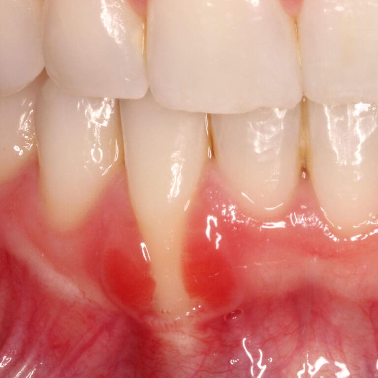 Gum graft healing stages Highlands Ranch Periodontics